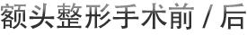 额头整形手术前/后
