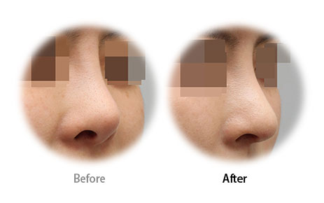 Case11 Before and After