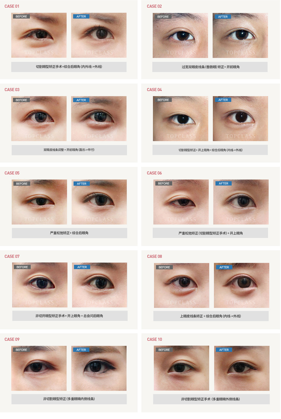 双眼皮修复手术前/后