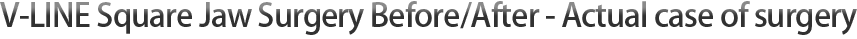 V-LINE Square Jaw Surgery Before/After - Actual case of surgery