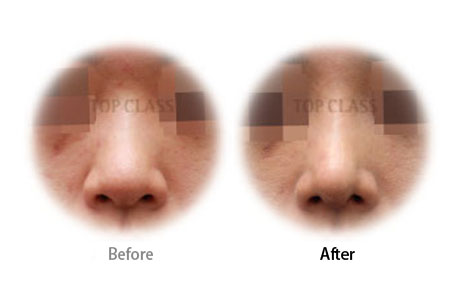 Case11 Before and After