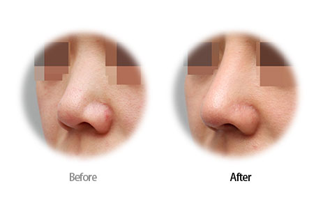 Case11 Before and After