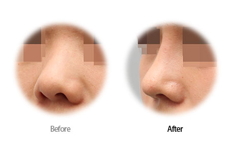 Case14 Before and After