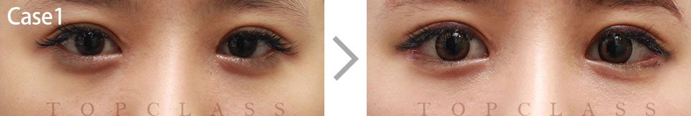 Case1 Magic Inner Corner Fold Removal（Canthoplasty）Before/After