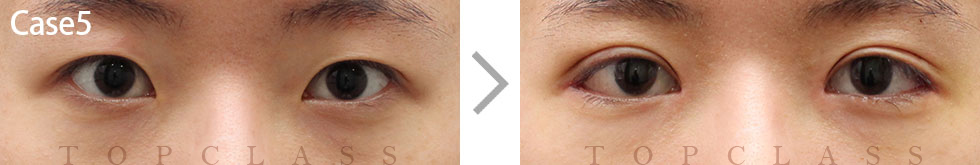 Case5 Magic Inner Corner Fold Removal（Canthoplasty）Before/After