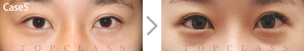 Case5 Multi Outer Corner Extension（Lateral Canthoplasty）Before/After
