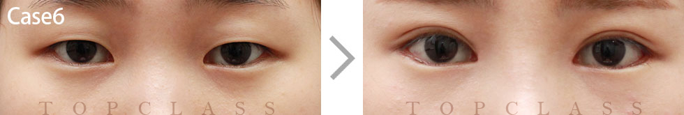 Case6 Multi Outer Corner Extension（Lateral Canthoplasty）Before/After

