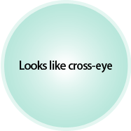 眼睛看起来向 内聚拢的情况