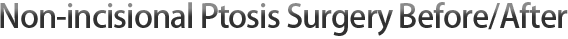 Non-incisional Ptosis Surgery Before/After