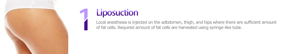 1 Liposuction, Local anesthesia is injected on the stomach, thigh, and hips where there are sufficient amount of fat cells. Required amount of fat cells are harvested using syringe-like tube.