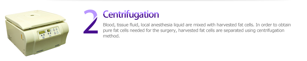 2 Centrifugation, Blood, intestinal juice, local anesthesia liquid are mixed with harvested fat cells. In order to obtain pure fat cells needed for the surgery, harvested fat cells are separated using centrifugation method.